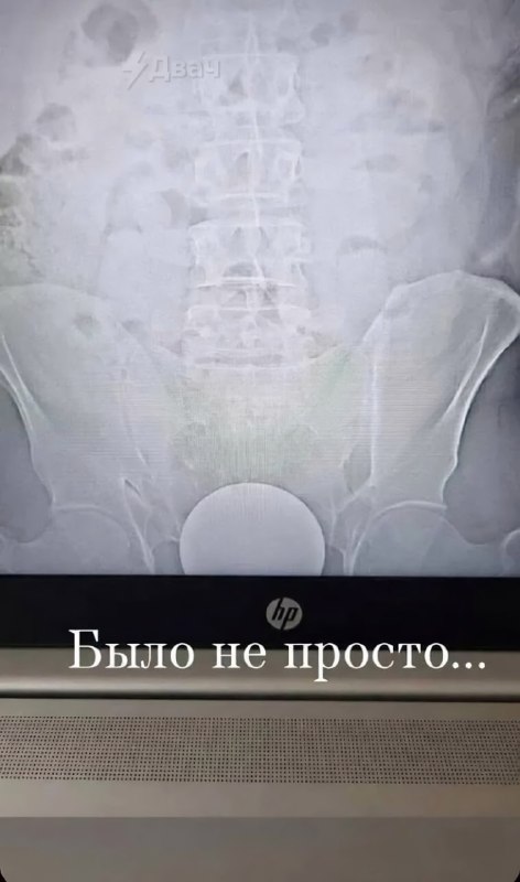 Москвич засунул стеклянный шар диаметром 10 см в свою жопу и попал в больницу
Шар застрял у него в