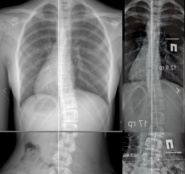 Коррекция позвоночника (сколиоз и гиперкифоз) теперь д...