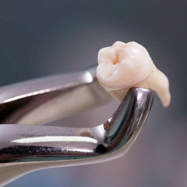 В Тверской области у 34-летнего Александра удалили зуб ?...