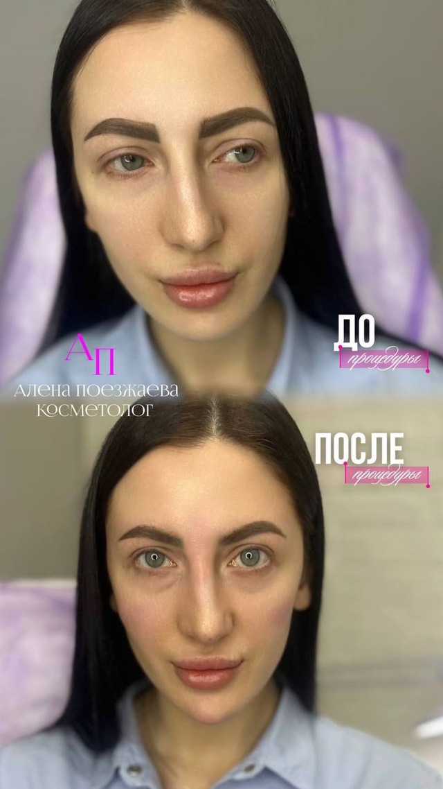 FULL FACE ПОД КЛЮЧ! ВСЁ ЛИЦО - ОДНОЙ ПРОЦЕДУРОЙ! ?
Специаль...
