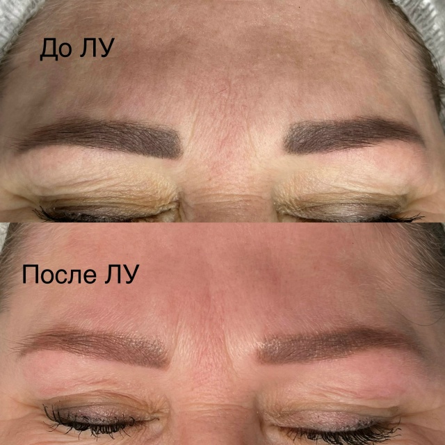 Лазерное осветление (удаление) перманентного макияжа: ...