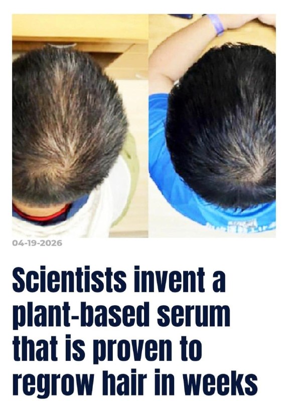 Облысение ВСЁ
Китайские учёные разработали растительную сыворотку, которая буквально будит спящие л