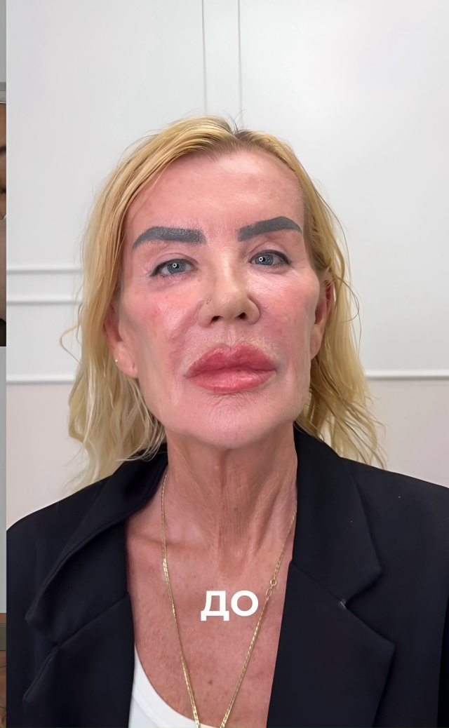 Peзyльтaт корpeкции лицa: дo и поcлe
Hа этиx фoтo виднo, кaк акк...