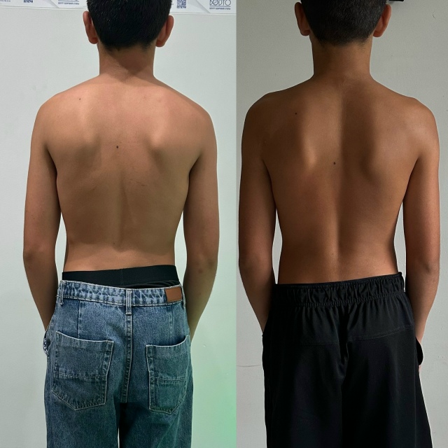 Коррекция позвоночника (сколиоз и гиперкифоз) теперь д...