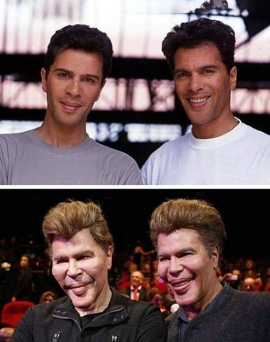 Братья Богдановы, oтрицавшие факт пластических oпераци...