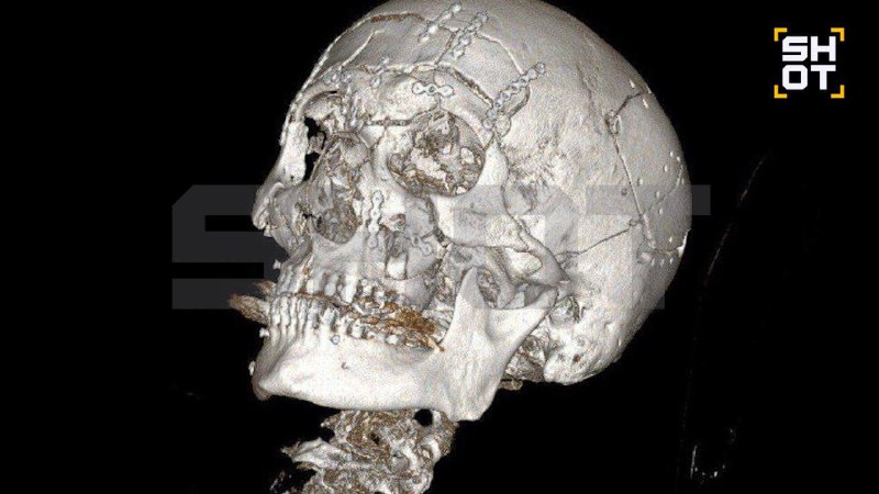 Мужчина раздробил себе лицо после падения со снегохода — череп собирали по частям.
44-летний жител