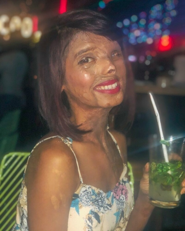 Анмол Родригес из Мумбаи, Индия, ослепла на один глаз и ...