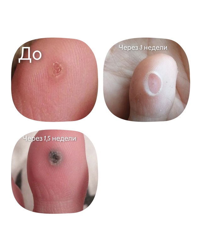 Специалист-подолог приглашает жителей Акбулака и близ...