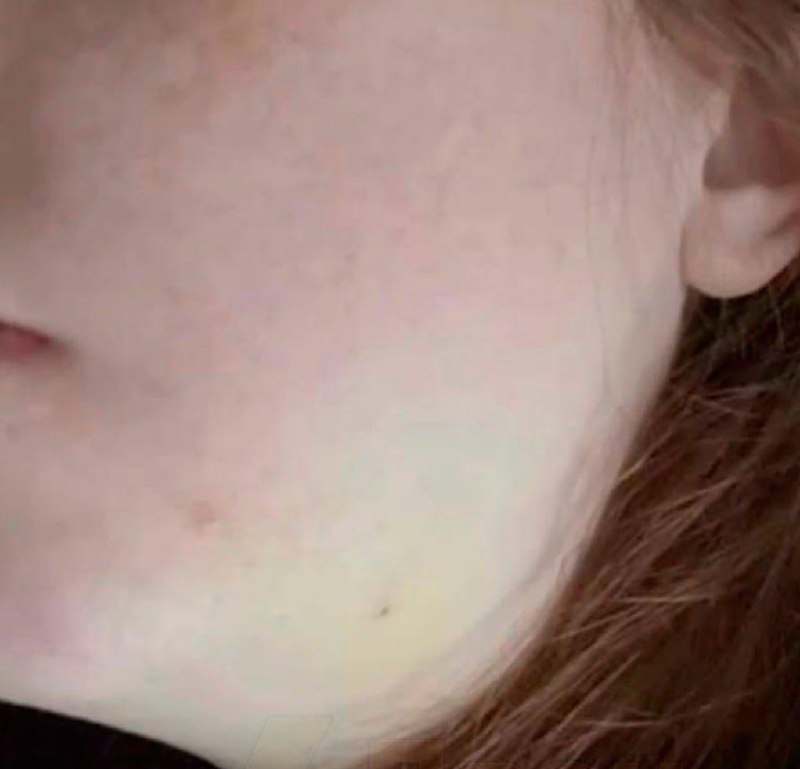 Москвичка чуть не умерла из-за удаления зуба мудрости.
В клинику пришла на плановое удаление — зуб