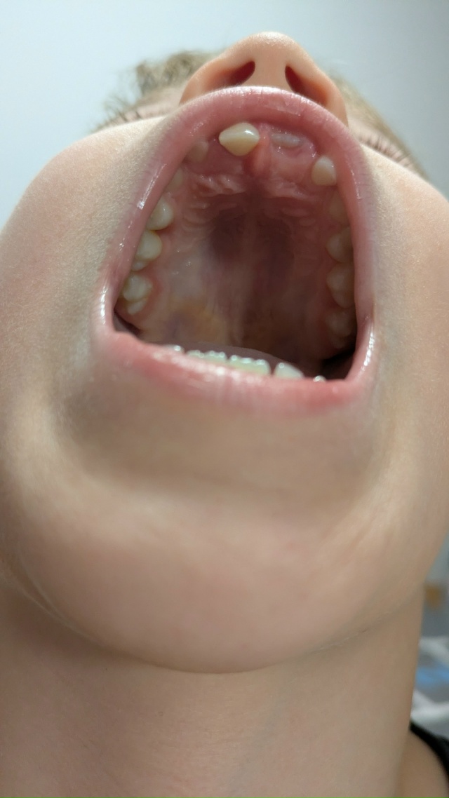 Здравствуйте. Помогите понять, это суженное твердое нё...