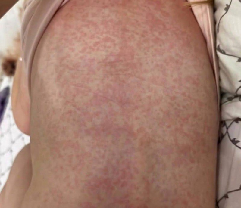 Пятилетняя девочка покрылась сыпью и отекла после того, как съела Kinder.
Ребёнок проснулся с силь