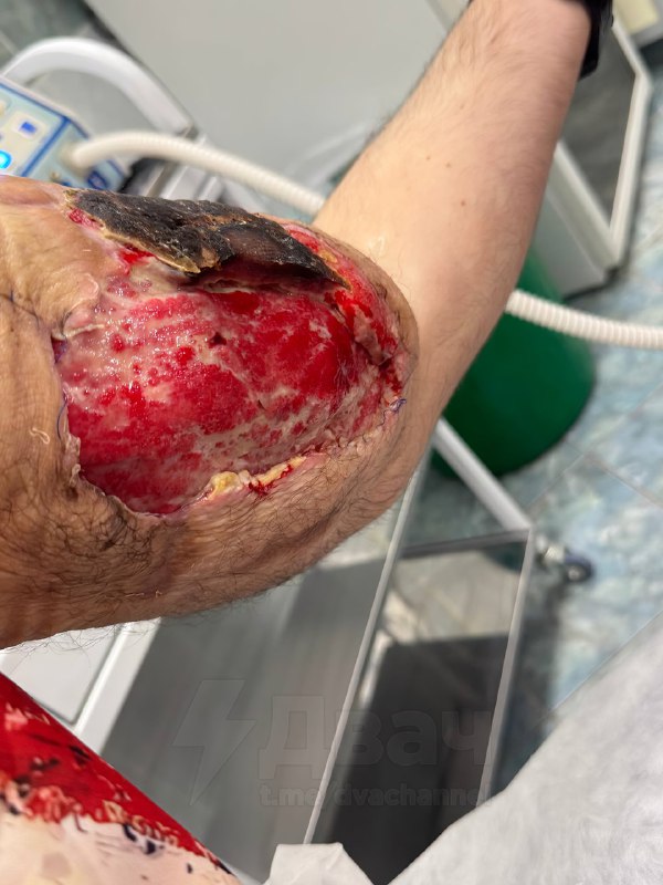 Не для слабонервных: помните, был такой Кирилл Терёшин aka «Руки-Базуки», который накачал свои бицух