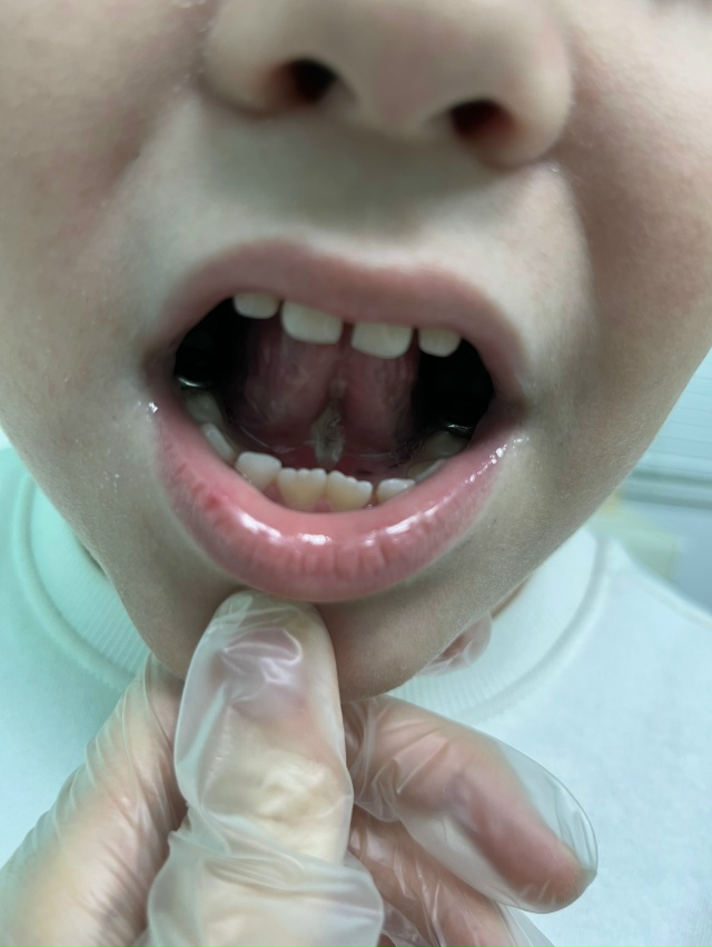 Анонимно. На фото итог операции на подъязычную уздечку...