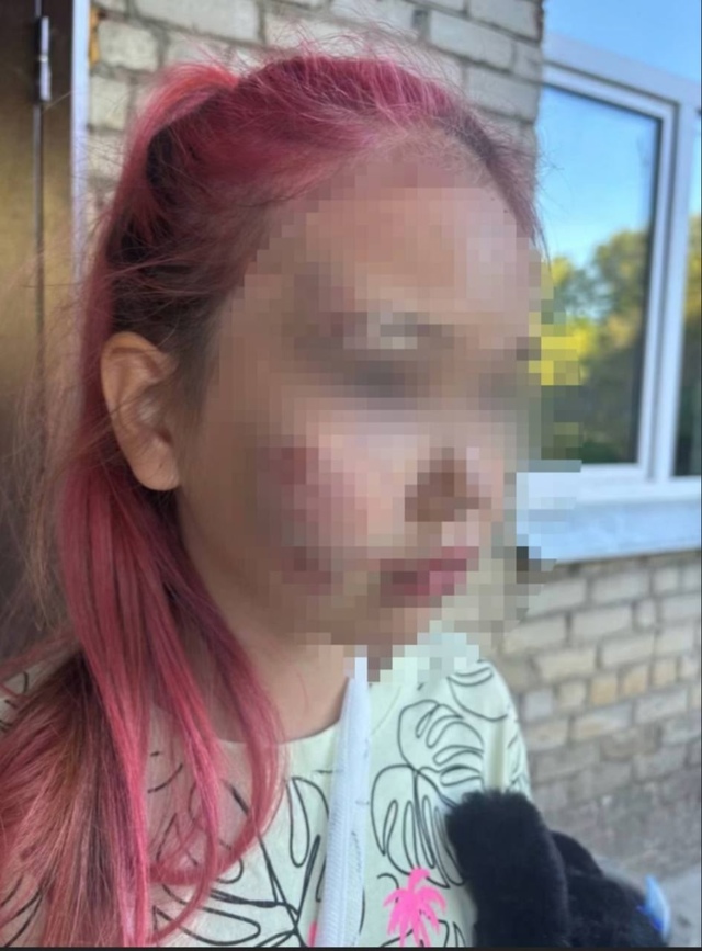8-летняя девочка получила серьезные травмы в детском л?...