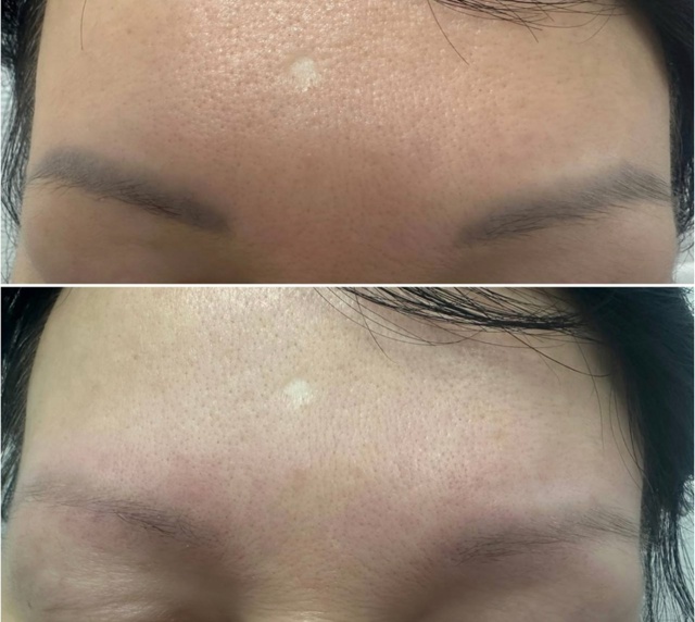 Лазерное осветление (удаление) перманентного макияжа: ...